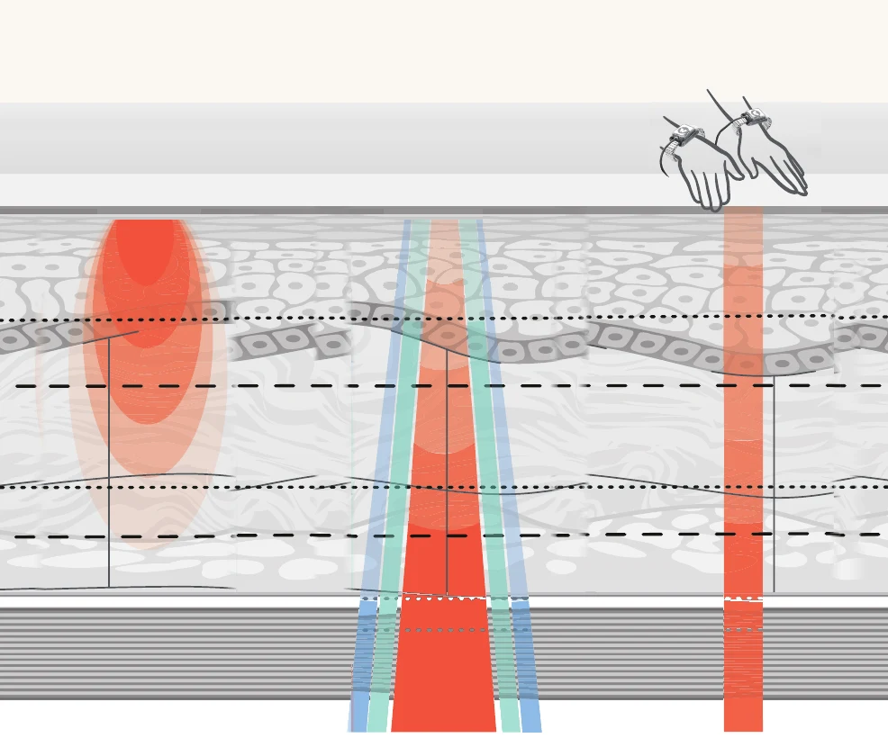 Side cross-section of facial skin showing surface, deeper tissue and muscle